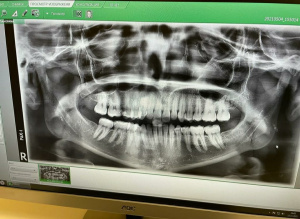 Рентген аппарат VATECH Pax-I